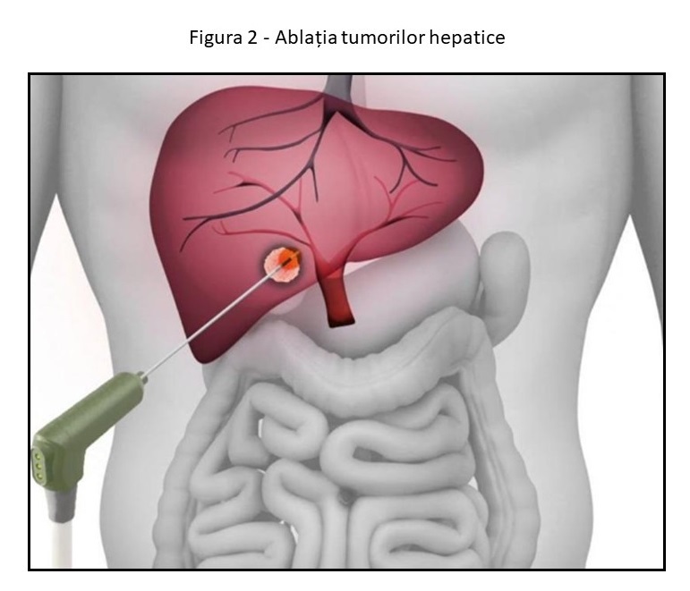 Figura 2 - Ablatia tumorilor hepatice