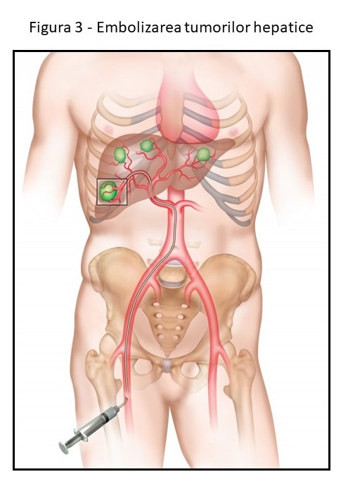 Figura 3 - Embolizarea tumorilor hepatice